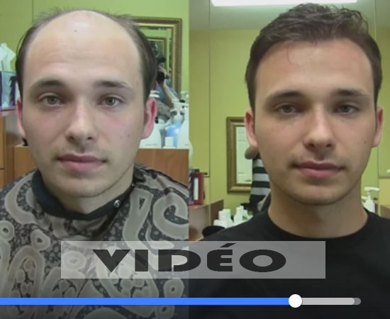 Prothèse capillaire